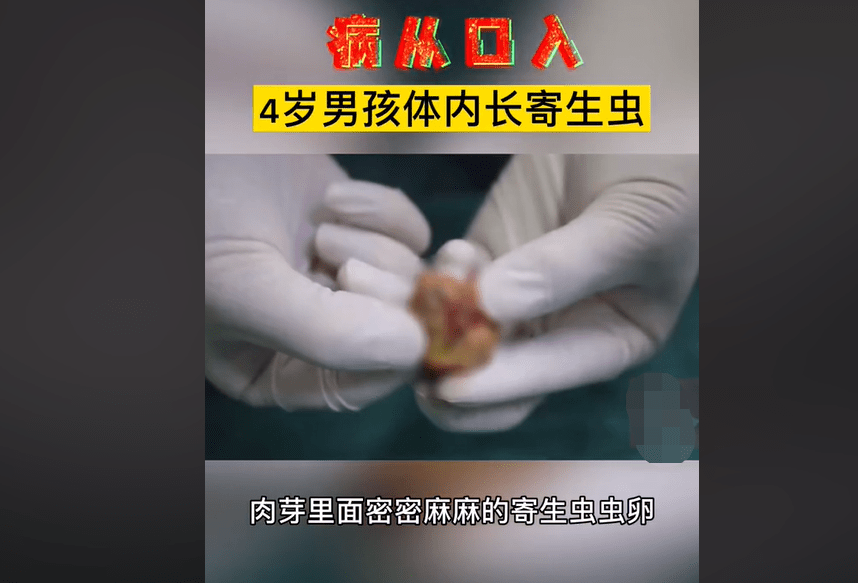 原创4岁孩子体内长虫医生手术取出一窝虫卵爸爸娃爱吃这类肉