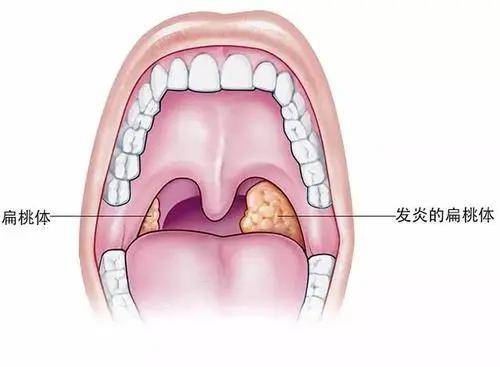 保定民众耳鼻喉医院:扁桃体炎与咽炎的区别
