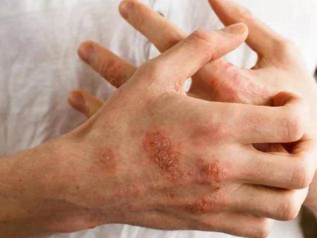 湿疹常见 的 表现为红斑,丘疹,水疱,脱屑,瘙痒,糜烂,渗液等症状,常