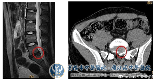 椎间孔镜手术成功救治腰间盘突出瘫痪少年