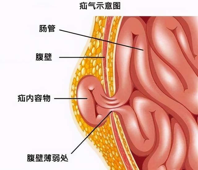 九旬老人疝病发作心肺功能又不好怎么办