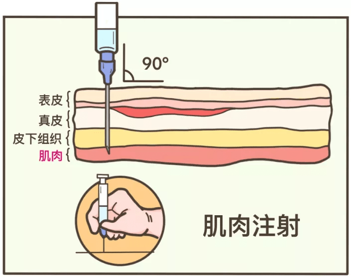 最痛:皮内注射 (代表:打青霉素前做的「皮试」)