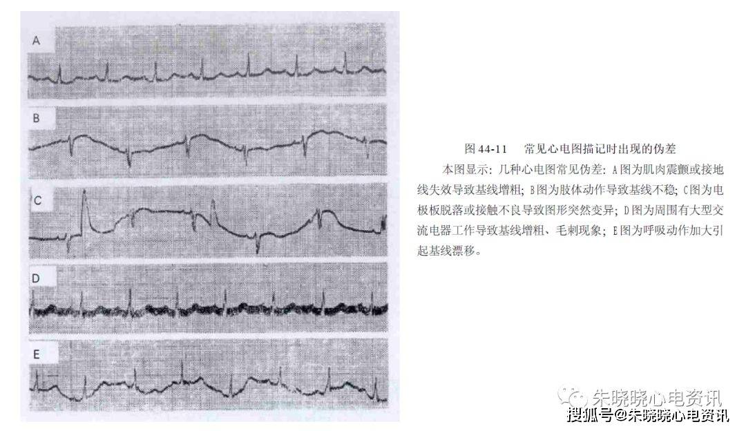 患者精神紧张或天气寒冷造成肌肉震颤,导致心电图基线增粗,增宽,毛刺