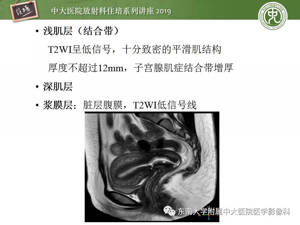 子宫详细解剖及磁共振信号分析