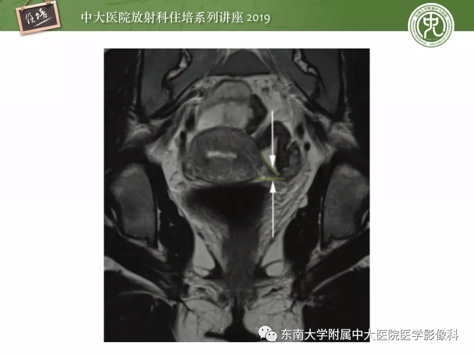 子宫详细解剖及磁共振信号分析