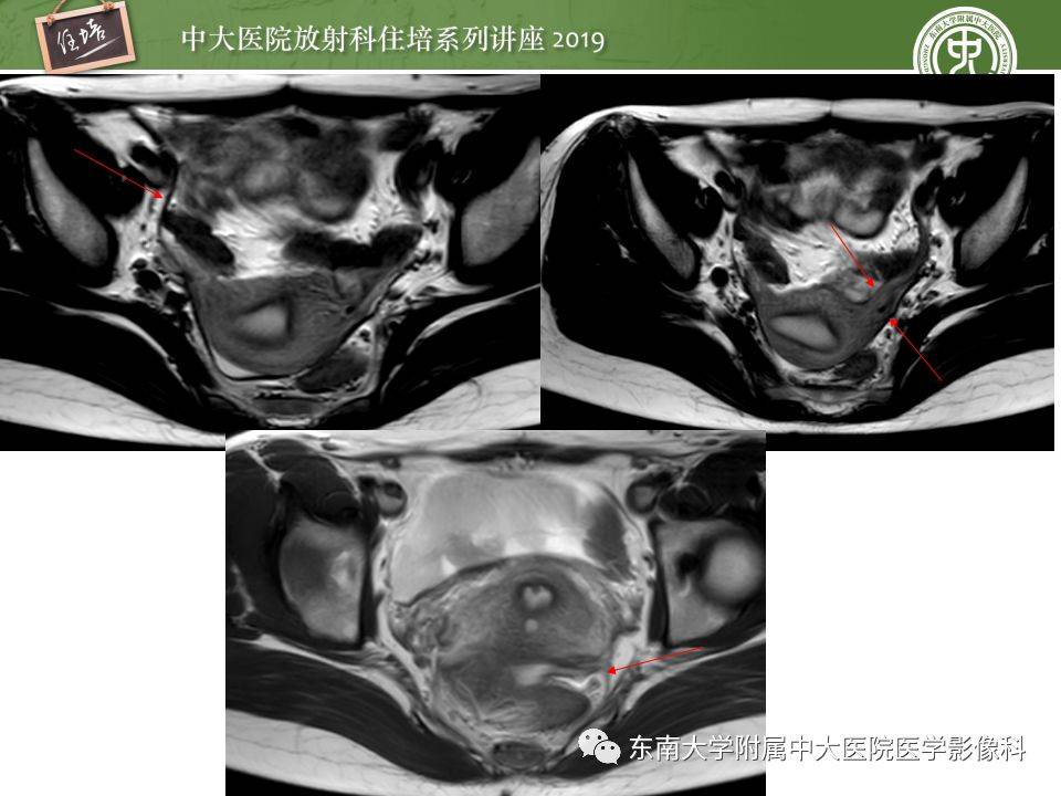 子宫详细解剖及磁共振信号分析