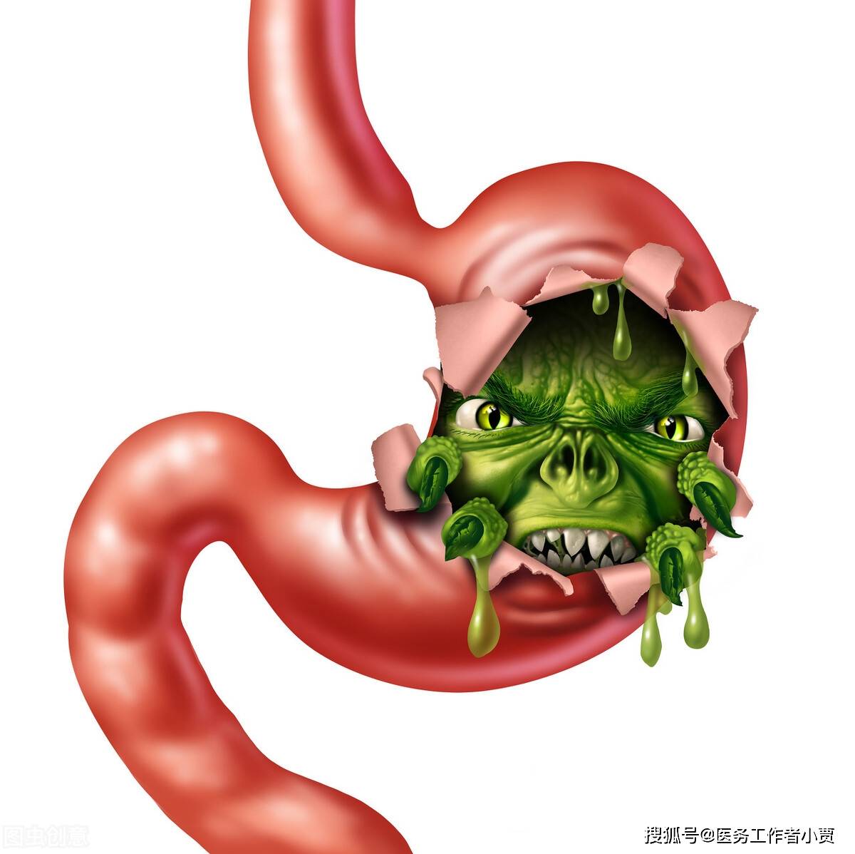 幽门螺杆菌的自述:胃癌是如何恋上我的?