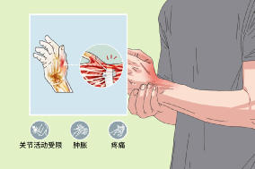 断手病腱鞘炎这些人群高发张继科因此无缘奥运