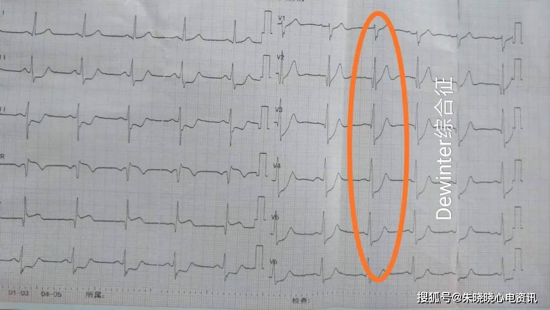 心梗只知道st段抬高?这 4 种高危心电图你不可不知