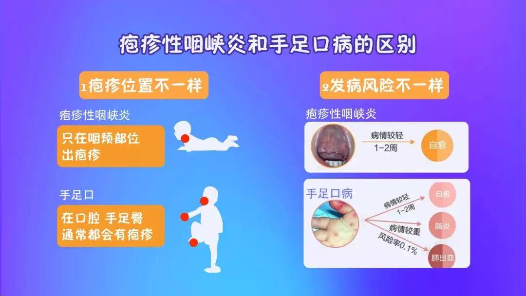 疱疹性咽峡炎终结版——知道这么多,就一点都不可怕