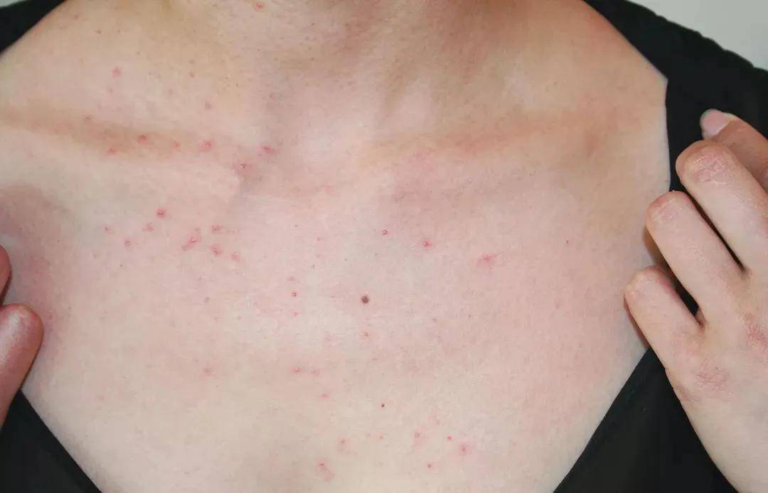 胸前,后背的"痘痘"可能不是普通痤疮,而是毛囊炎,还需要警惕马拉色菌