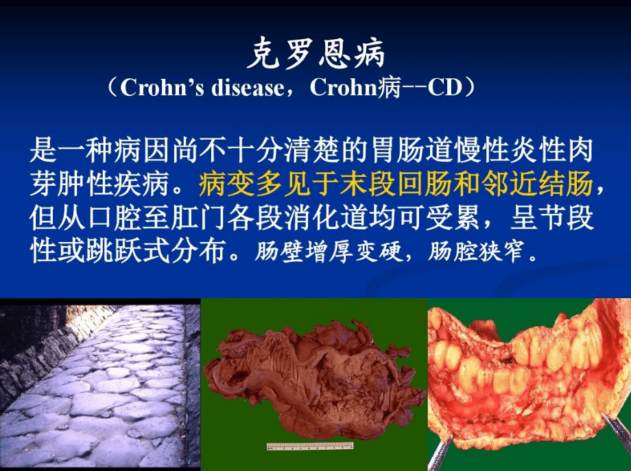 1周瘦6斤是好事吗?腹泻腹痛都要警惕起来,小心克罗恩病