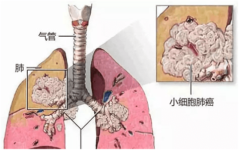 确诊小细胞肺癌晚期,化疗联合中药治疗,让我看到了希望!