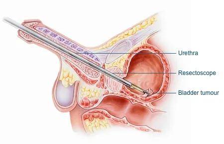 经尿道膀胱肿瘤切除术(turbt)