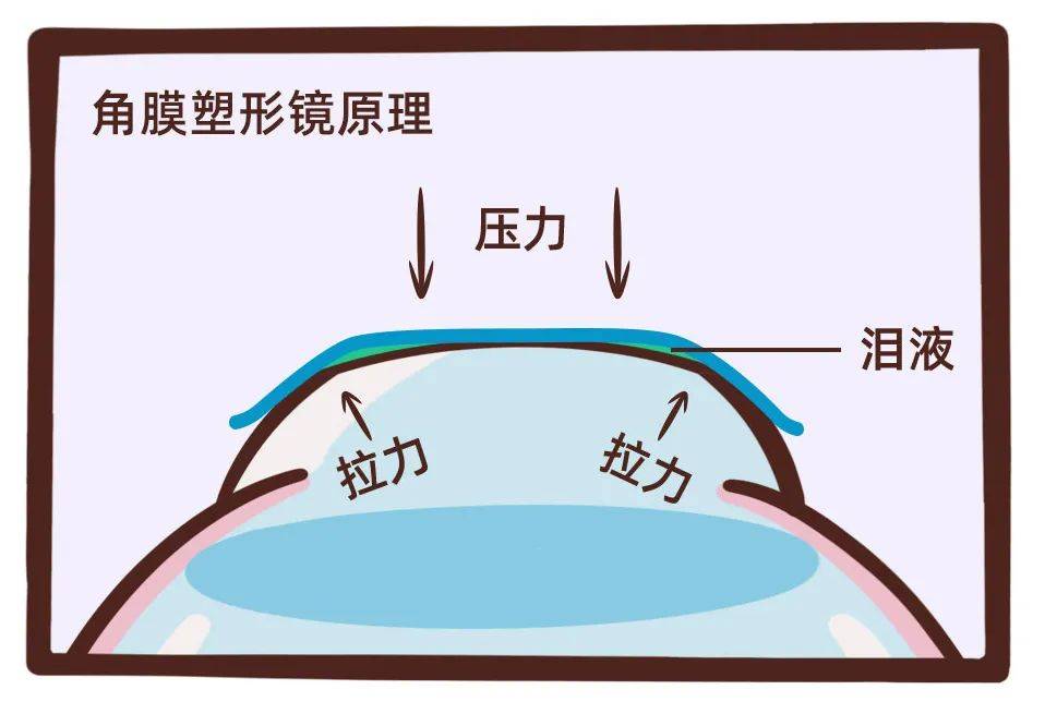 *角膜塑形镜原理示意 角膜塑形镜的塑形过程是可逆的,坚持配戴才有