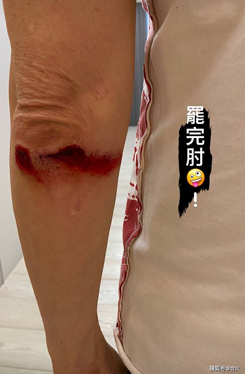 60岁庾澄庆骑自行车摔伤流血,手脚多处严重破皮,腿上还有车轮印