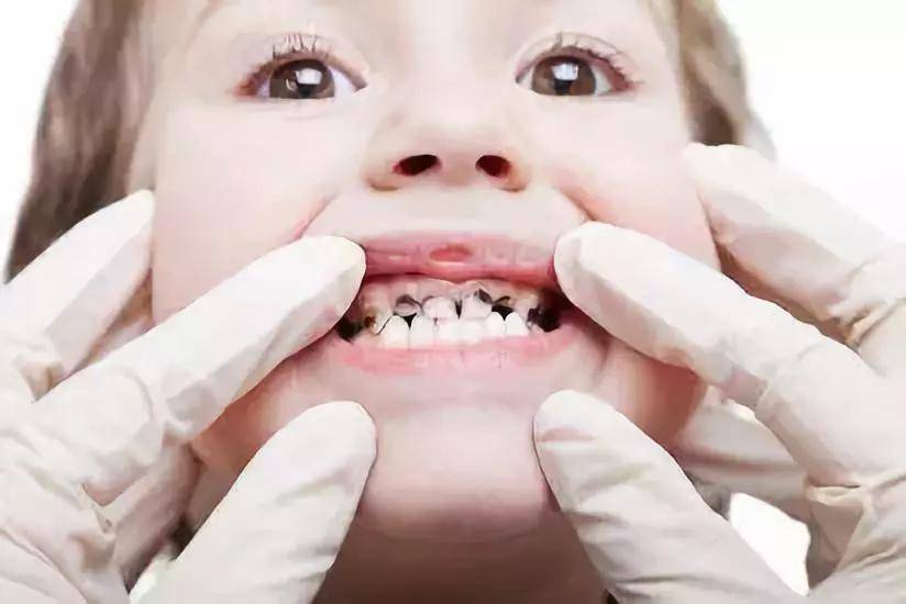 12岁前必须处理的12种儿童牙颌畸形_牙齿