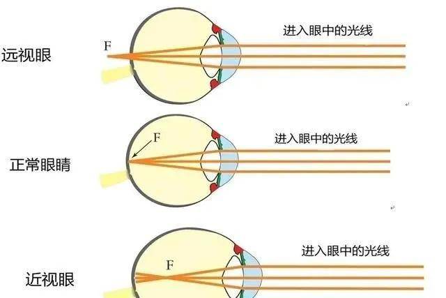 云采近视防控眼镜:孩子的远视储备不足,还有多久就会近视?