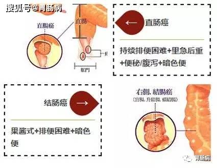 原创大便带血要小心!这种情况,可能是癌!