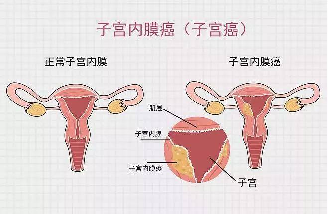 患上妇科肿瘤,身体早就发出信号!女孩们,请注意!