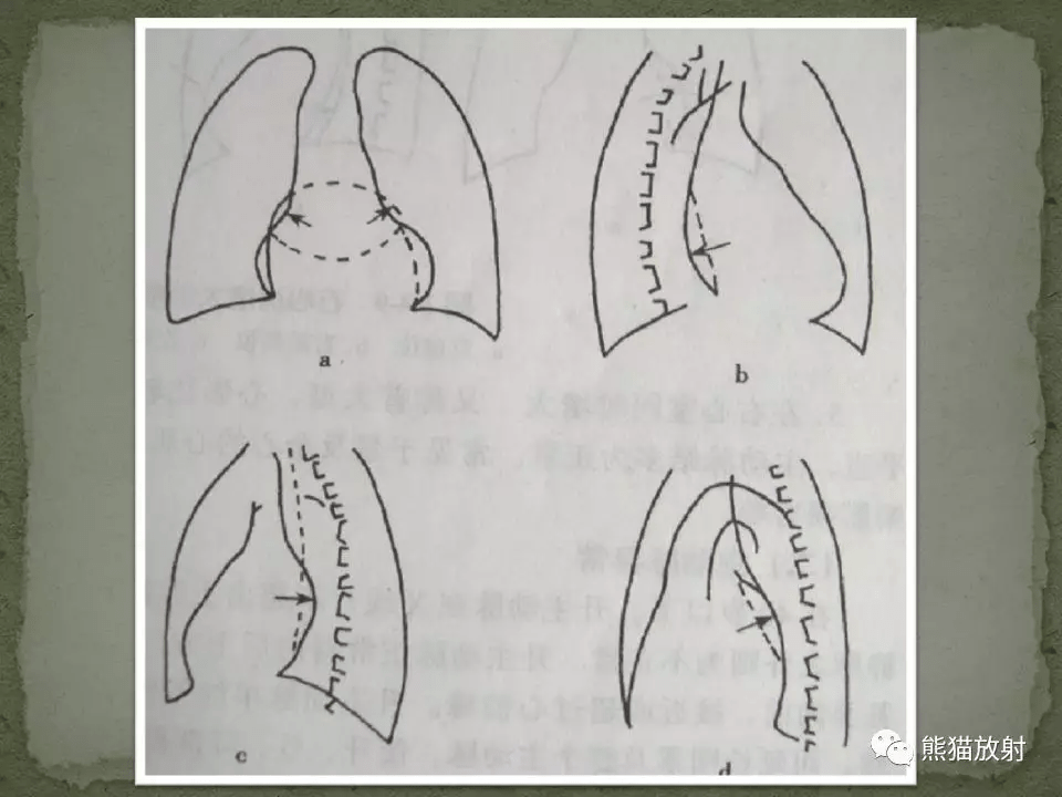 心脏和大血管病变的x线表现