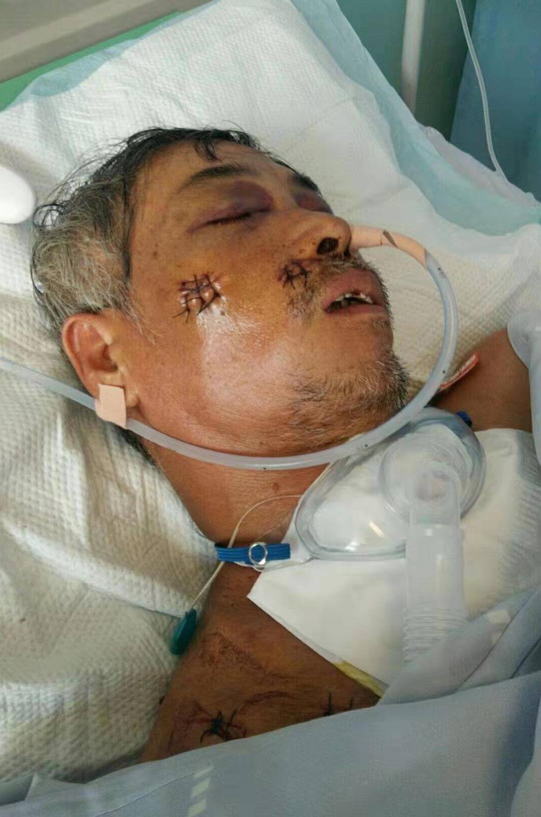 一场车祸让59岁父亲重伤在院南宁市孝子为父救助求大家救救我的父亲