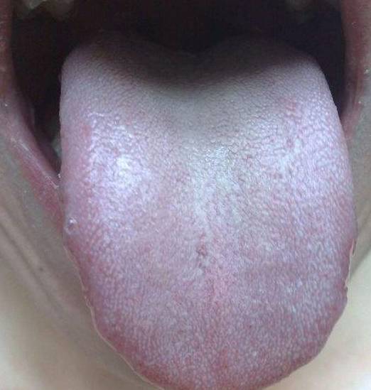 从舌头看看你健不健康 舌头出现这8种症状可不要忽视