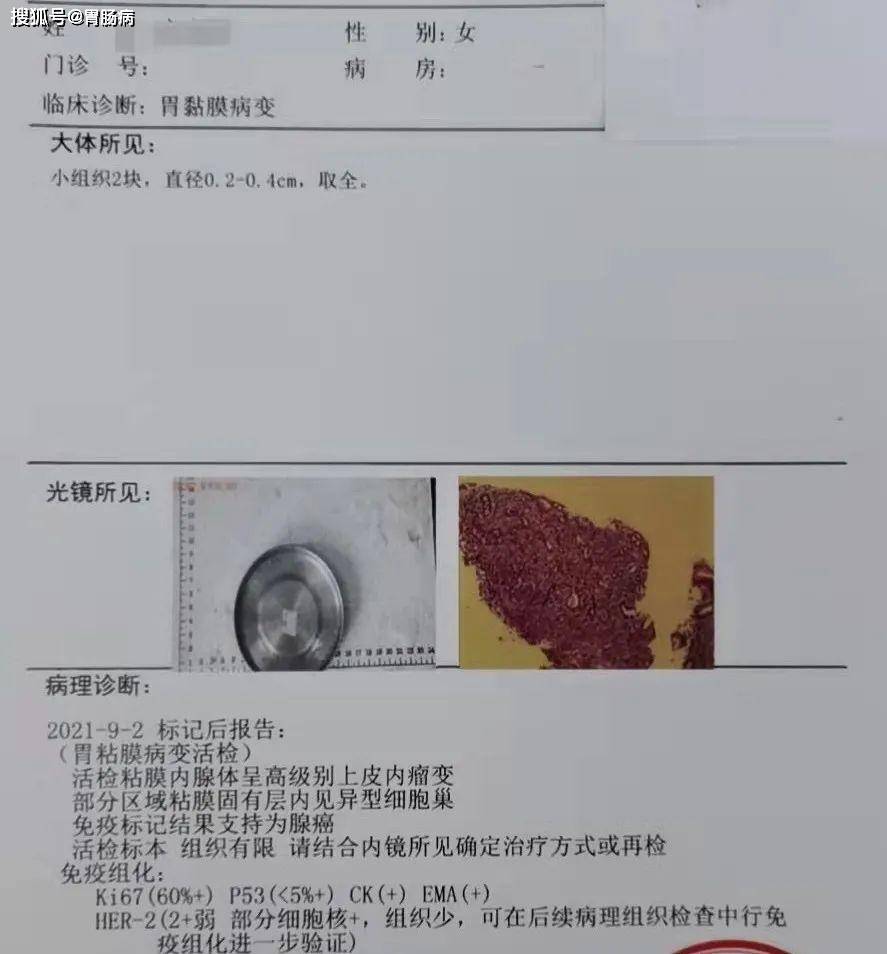 取了根鱼刺,逮住个胃癌—年过40不做胃镜,后悔都来不及