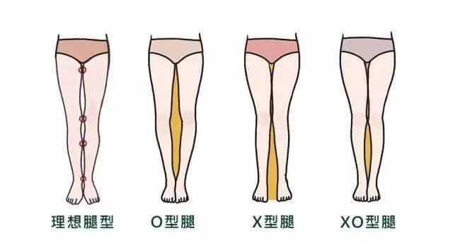 通常腿型不佳则表现为o型腿,x型腿和xo型腿三种腿型,这几种腿型往往