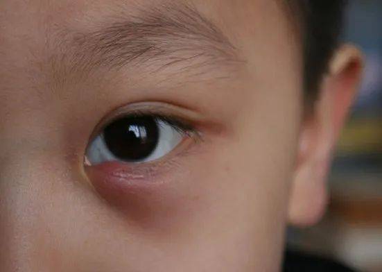 "针眼"是睑腺炎的俗称,又称"麦粒肿",是由眼睑的睑板腺或毛囊及其