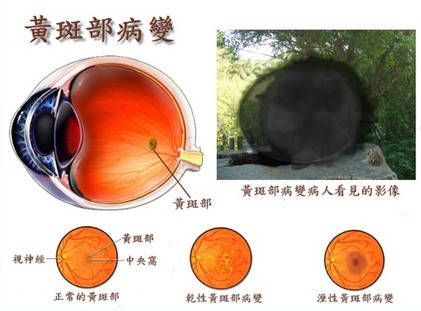 8,黄斑变性