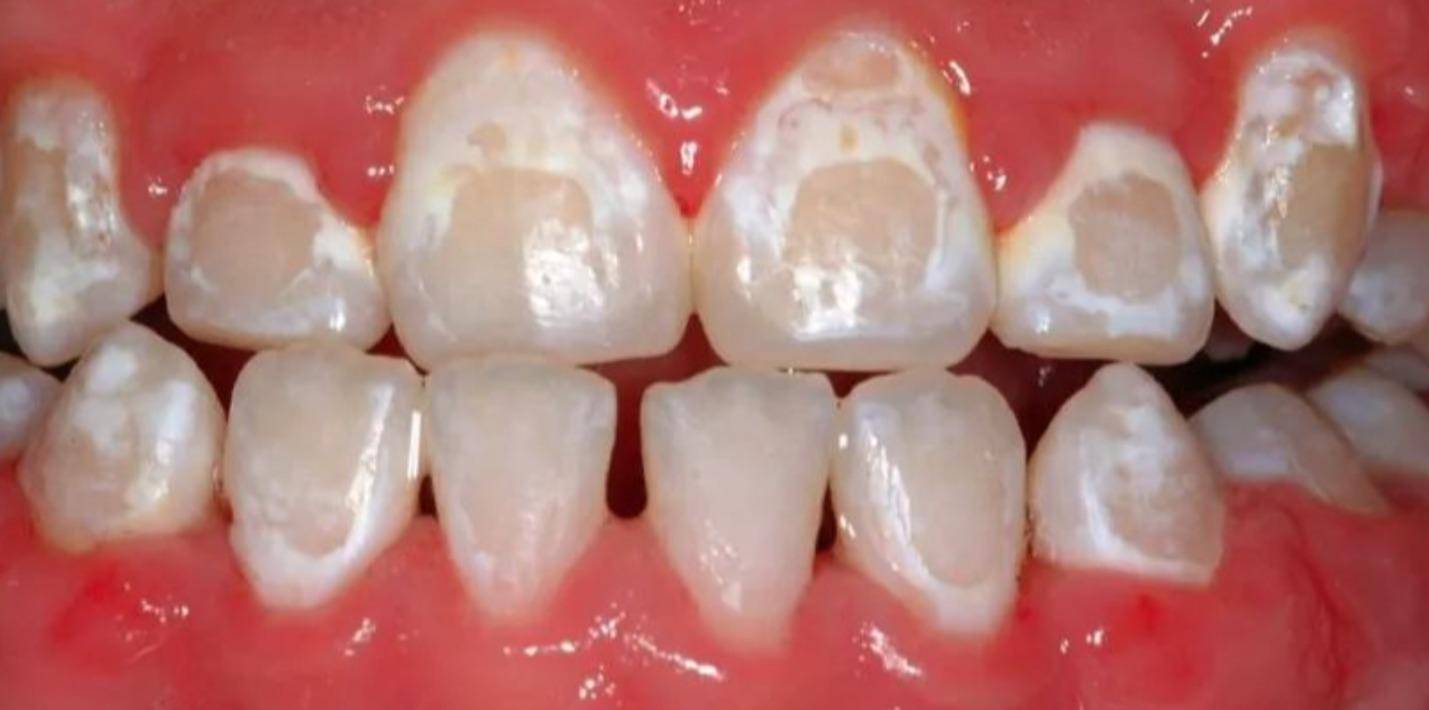 萌出后,下面这些后天因素就成为牙齿不美观的主要因素:牙釉质发育不全