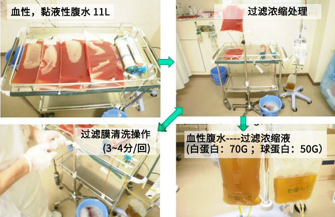 腹水治疗最前线日本kmcart系统有效缓解恶性腹水