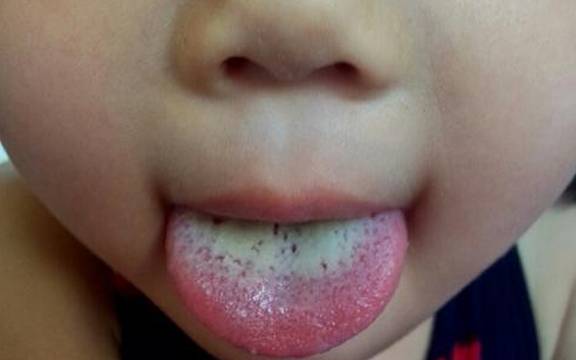 看孩子的舌苔如果你的孩子厌食,萎靡不振,不妨用以下的方法来确定孩子