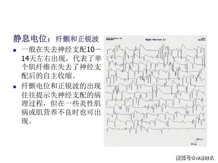 临床笔记一文读懂肌电图的机制和应用基础