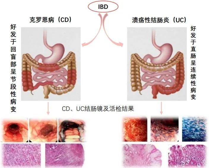 性结肠炎(ulcerative colitis,uc,两者的临床及病理特征存在重叠性