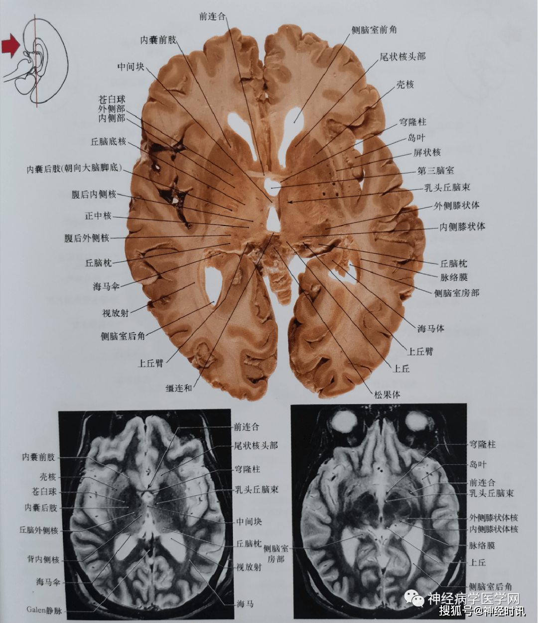 临床神经解剖图谱(断层影像 切片)_平面_丘脑_脑桥