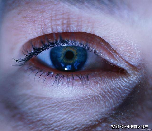 眼睛痒眼屎多干眼症9大qa一次看懂
