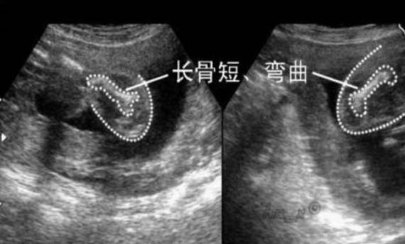 产检时,医生告知雯雯:她怀的是海豹胎,胎儿四肢非常短小,属于发育畸形