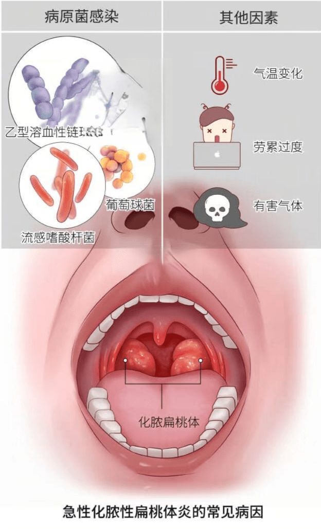 比较趋向性的结论是:总体上认为扁桃体切除术后1个月内,患者的免疫