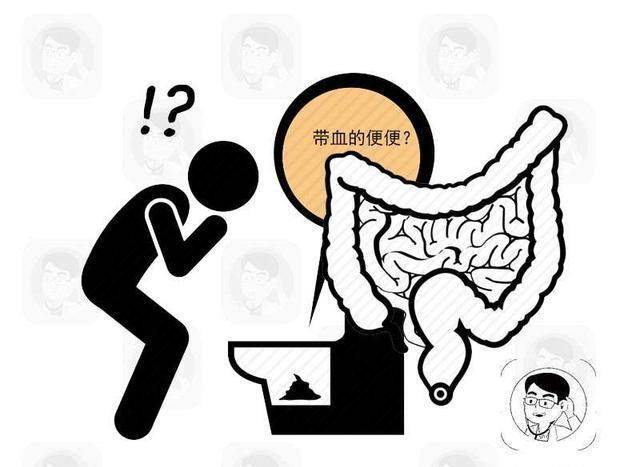 排出这样的大便,或许是大肠癌的""