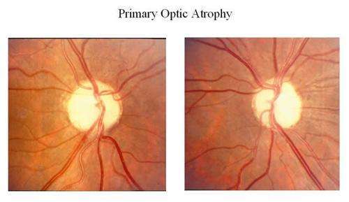 视神经萎缩的表现_病变_疾病_发展