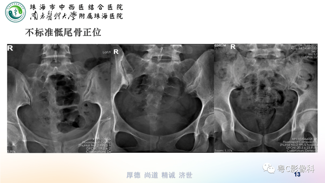 骶尾骨正侧位x线摄影