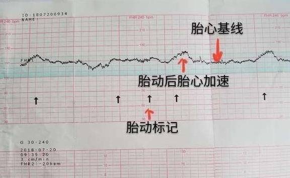 "为什么我没有做过胎心监护"怀孕28周的美美,听到一些妈妈说胎心监护