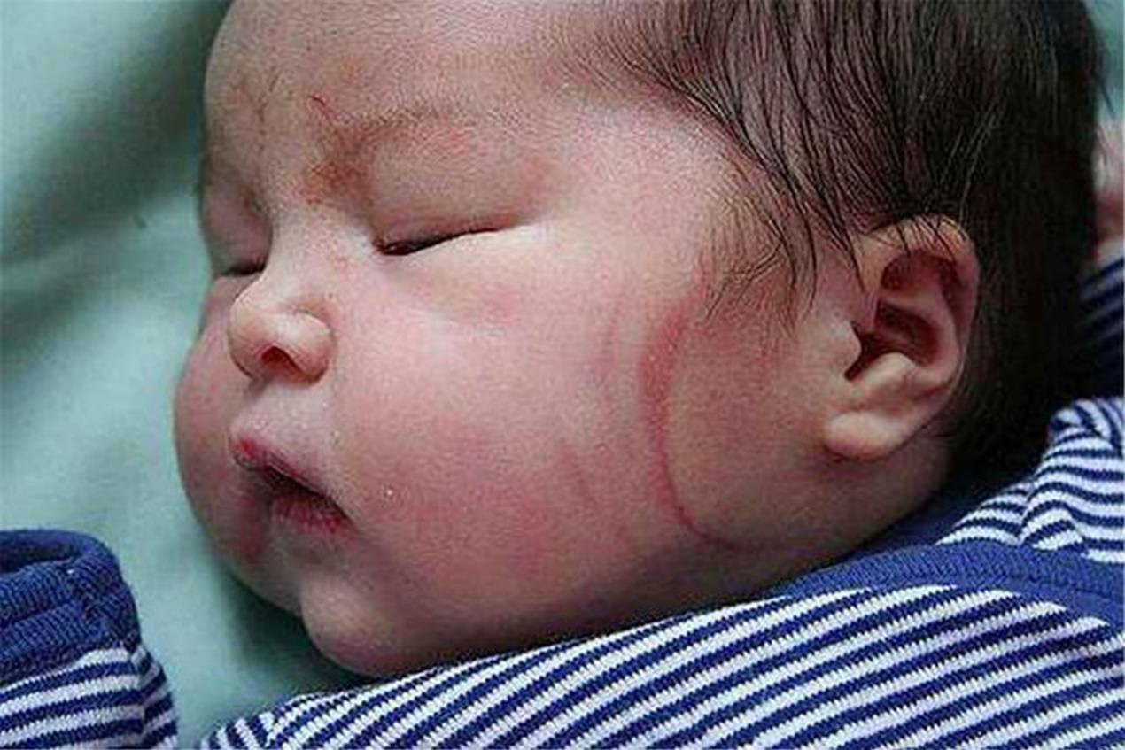 新生儿身上的＂淤青＂,是在产道中被挤压的,还是被医生拍的？