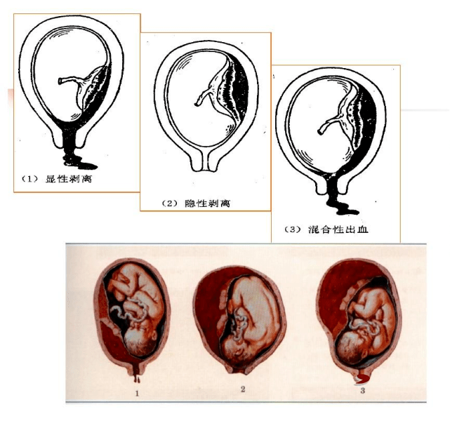 妈妈宫内出血宝宝命悬一线又是胎盘早剥这个致命杀手