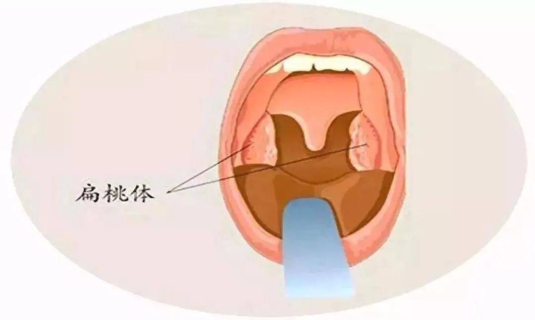 化脓性扁桃体炎最佳治疗方法成都民生耳鼻喉医院专业正规