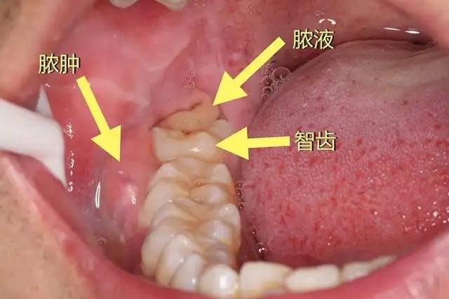 再加上长期不注重口腔清洁,容易出现复发性口腔溃疡,牙疼(常见有:智齿