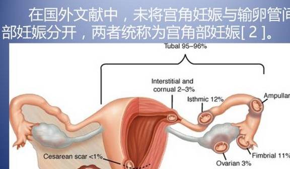 原创如何判断是宫角妊娠怀孕早知道
