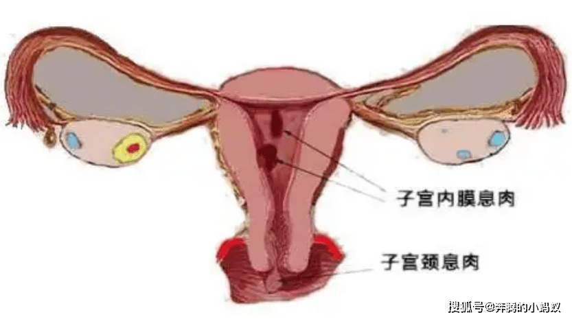 b超是诊断子宫内膜息肉比较常见的方法,并且能够发现绝大多数的子宫